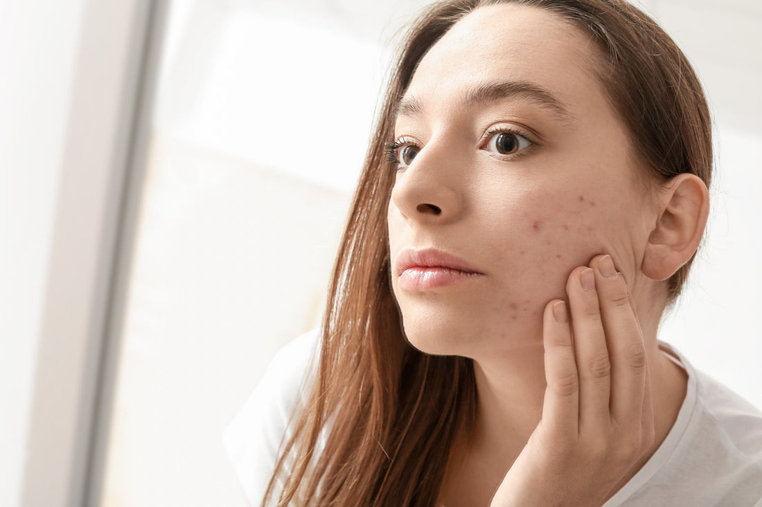 Skin Purging Vs Breakouts: How Estheticians Can Tell the Difference